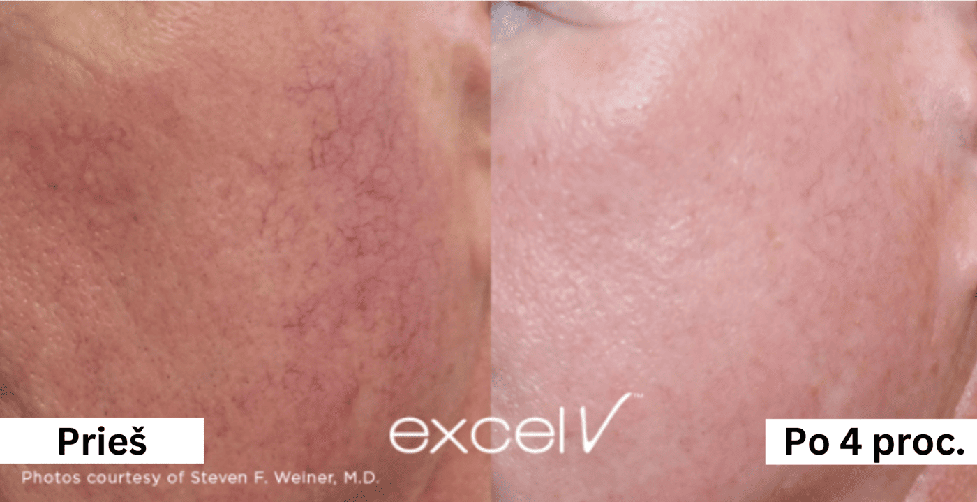 kapiliaru-salinimas-lazeriu